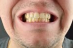 عادت‌های غلطی که دندان‌های را زرد می‌کند